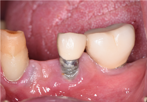 gum disease